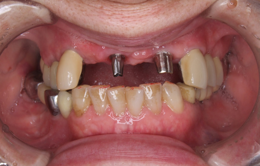 インプラント上顎前歯部症例