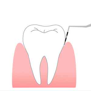 歯周ポケットの深さの減少