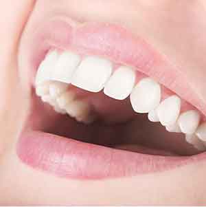 歯肉の炎症の改善