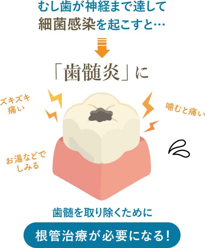 歯髄を取り除くために根管治療が必要になる!