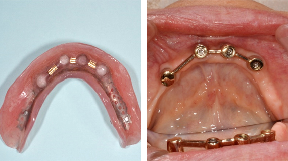 インプラント義歯（可撤性）