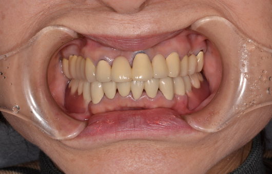 下顎アタッチメント義歯口腔内