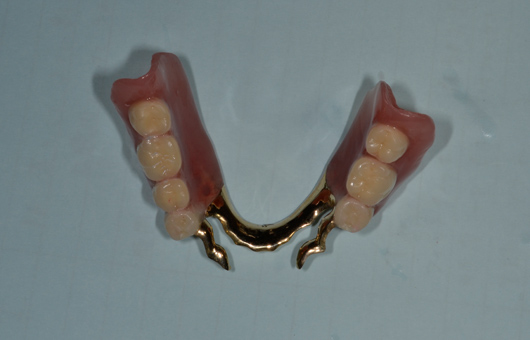 下顎アタッチメント義歯