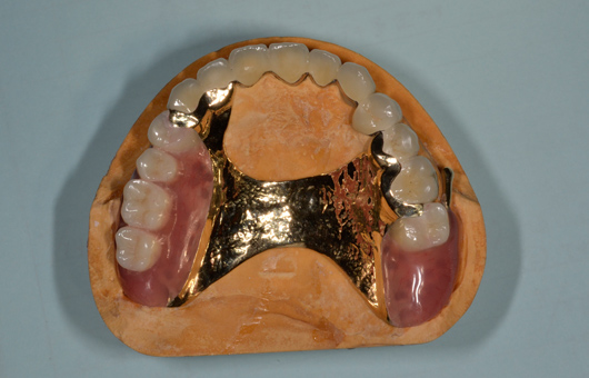 模型上でアタッチメント義歯が入った写真