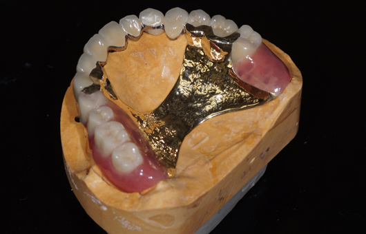 模型上でのアタッチメント義歯とセラミックブリッジ