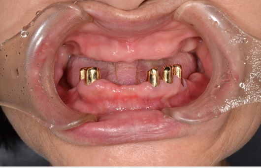 コーヌス義歯口腔内内冠