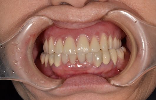 下顎コーヌス義歯装着、上顎は総義歯症例