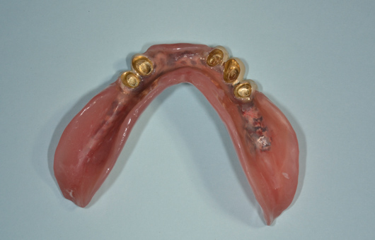 下顎コーヌス義歯