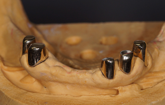 下顎コーヌス義歯内冠