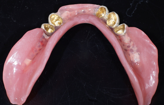 下顎コーヌス義歯外冠と下顎義歯