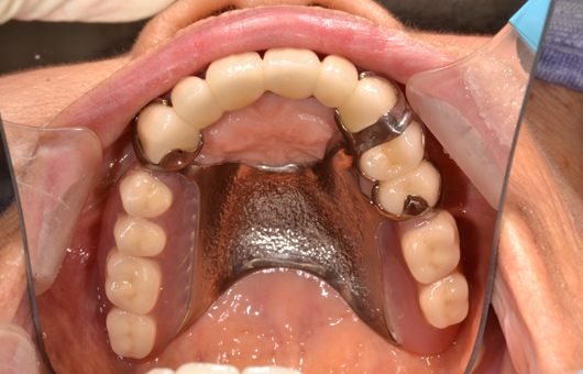 上顎クラスプ義歯口腔内装着症例写真