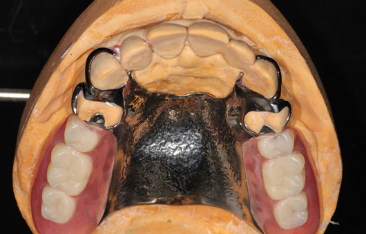 上顎クラスプ金属床義歯