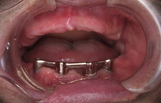 口腔内；上顎総義歯、下顎インプラント総義歯