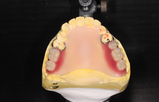 保険上顎部分義歯