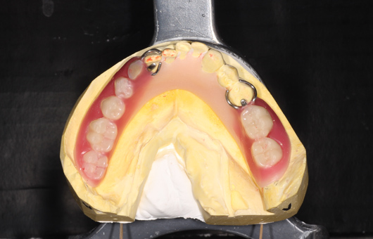 保険下顎部分義歯