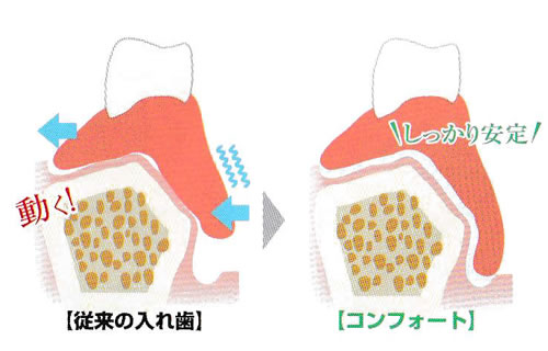 お口の中でがっちり固定、安定して外れにくい