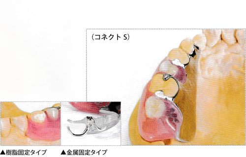 3本～歯を失った方へ幅広いご利用が可能