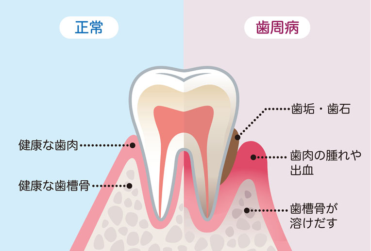 歯を失う第一位の病気